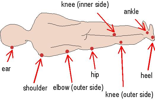 Pressure Sores Stages