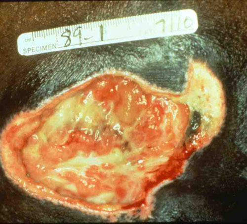 Pressure Sores Stages