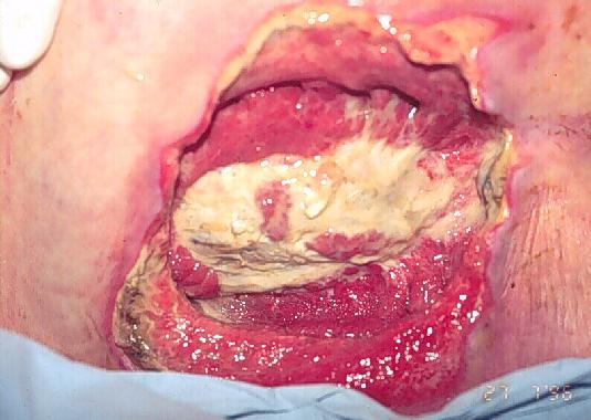 Pressure Sores Stages