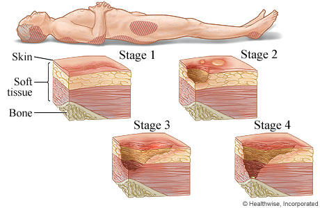 Pressure Ulcer Grading 2012