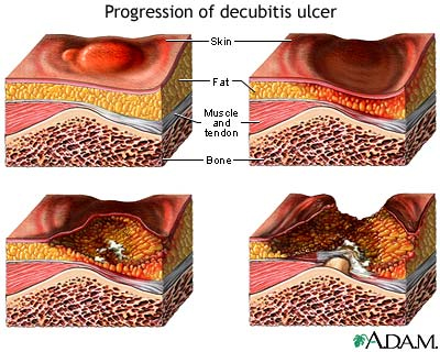 Pressure Ulcer Grading