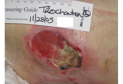 Pressure Ulcer Grading Chart