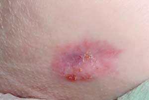 Pressure Ulcer Grading Images