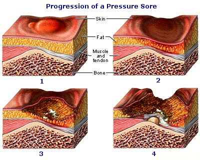 Pressure Ulcer Grading Images