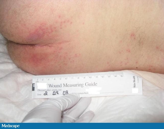 Pressure Ulcer Grading Images