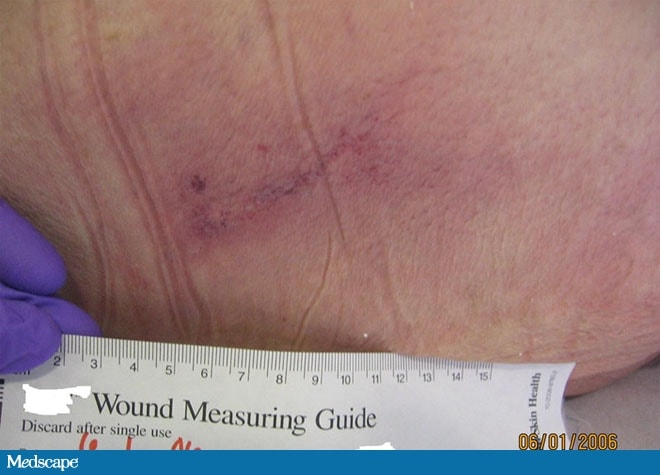 Pressure Ulcer Grading Tool