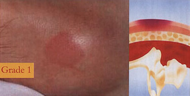 Pressure Ulcer Stage 1 Pictures