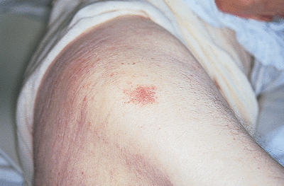 Pressure Ulcer Stage 1 Pictures