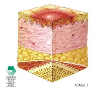 Pressure Ulcer Stage 2 Treatment