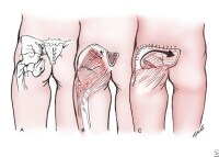 Pressure Ulcer Stage 2 Treatment