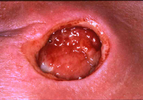 Pressure Ulcer Stage 4