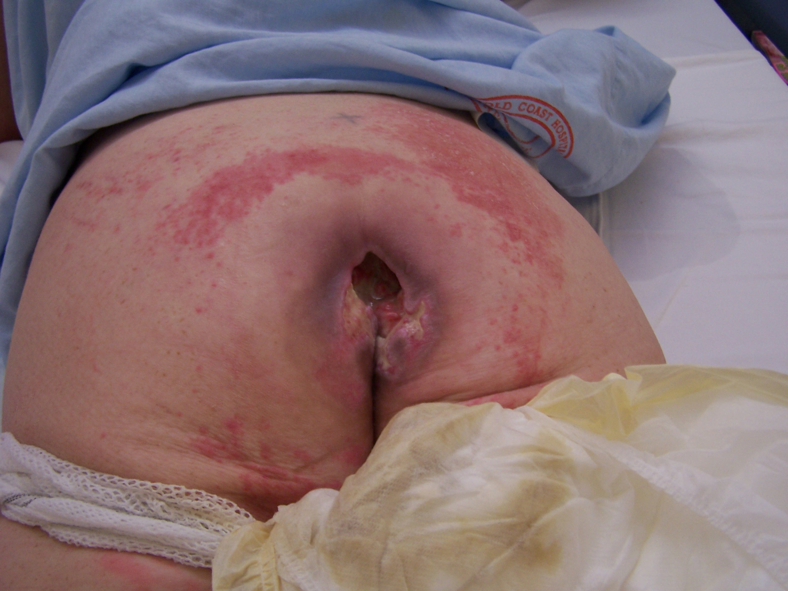 Pressure Ulcer Stage 4 Pictures