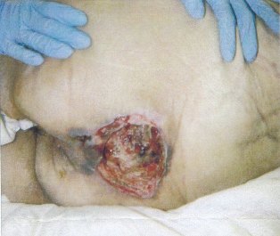 Pressure Ulcer Stage 4 Pictures