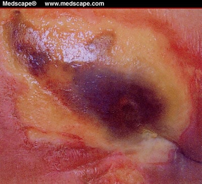 Pressure Ulcer Stage 4 Pictures