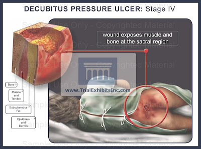 Pressure Ulcer Stage 4 Pictures