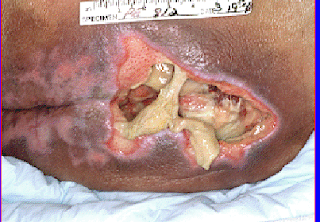 Pressure Ulcer Stage 4 Pictures