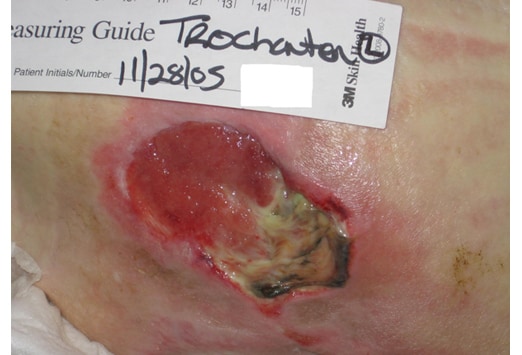 Pressure Ulcer Stage 4 Treatment