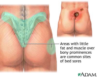 Pressure Ulcer Staging