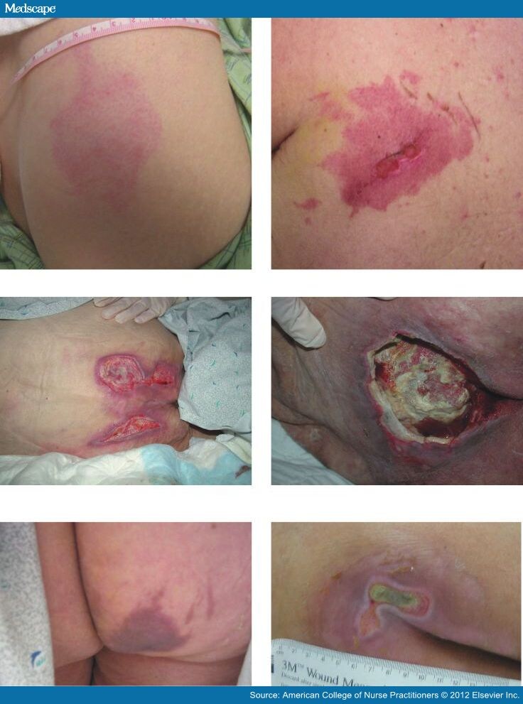 Pressure Ulcer Staging