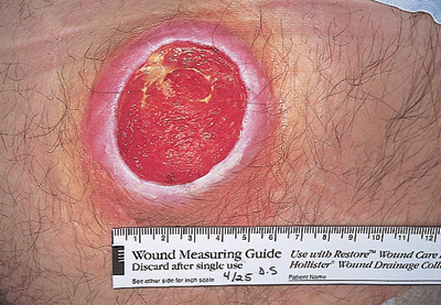 Pressure Ulcer Staging Guide