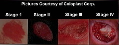 Pressure Ulcer Staging Quiz