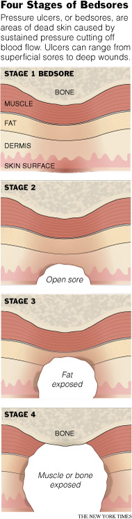 Pressure Ulcer Staging Quiz