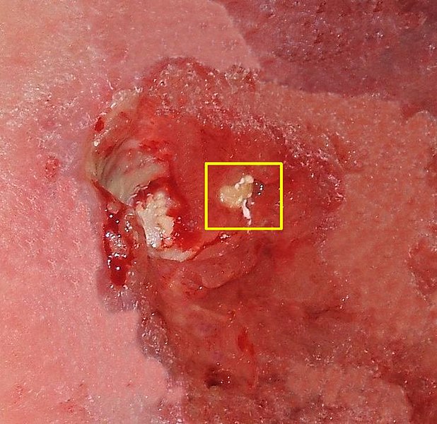 Pressure Ulcer Staging Treatment