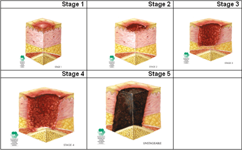 Pressure Ulcer Staging Treatment