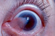 Pterygium And Pinguecula