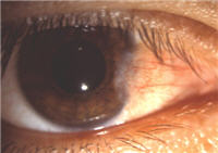 Pterygium And Pinguecula