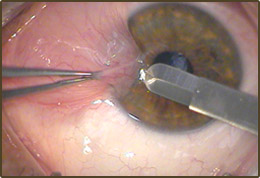 Pterygium And Pinguecula