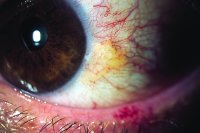 Pterygium And Pinguecula