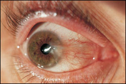 Pterygium And Pinguecula