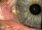 Pterygium And Pinguecula