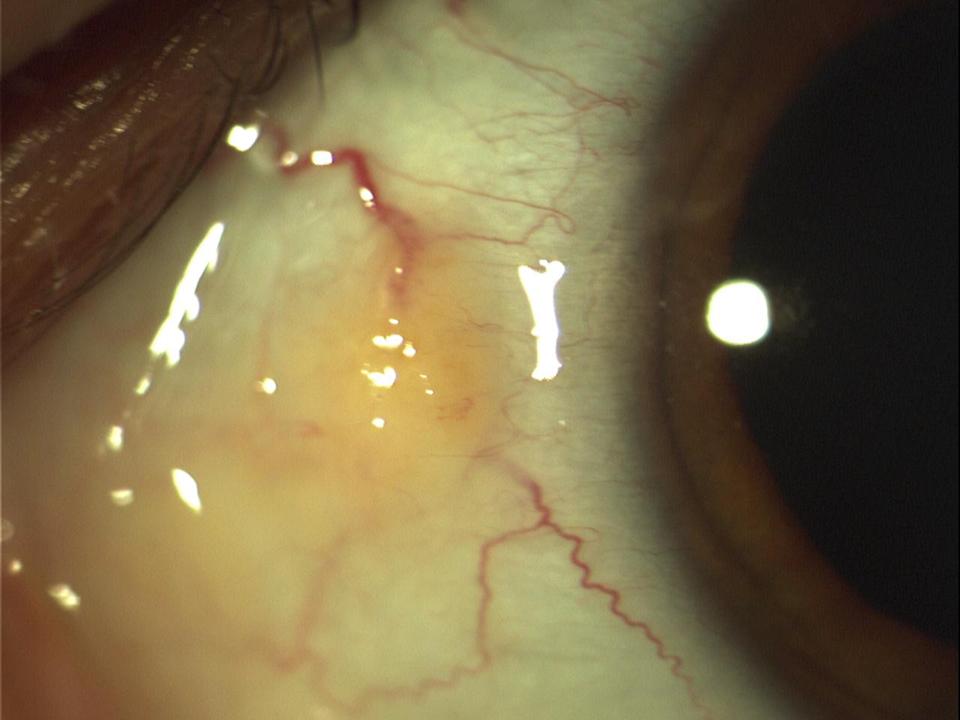 Pterygium And Pinguecula Picture