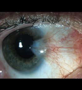 Pterygium Eye Cancer