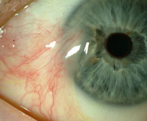 Pterygium Eye Cancer