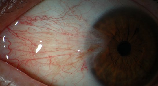 Pterygium Eye Cancer