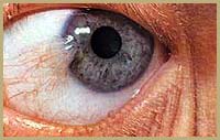 Pterygium Eye Disease