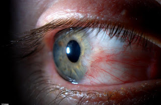 Pterygium Eye Disease