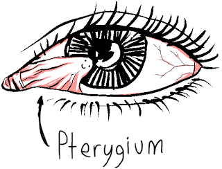 Pterygium Eye Pain