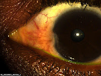 Pterygium Eye Pain