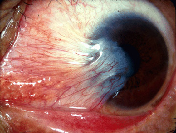 Pterygium Eye Surgery Recovery