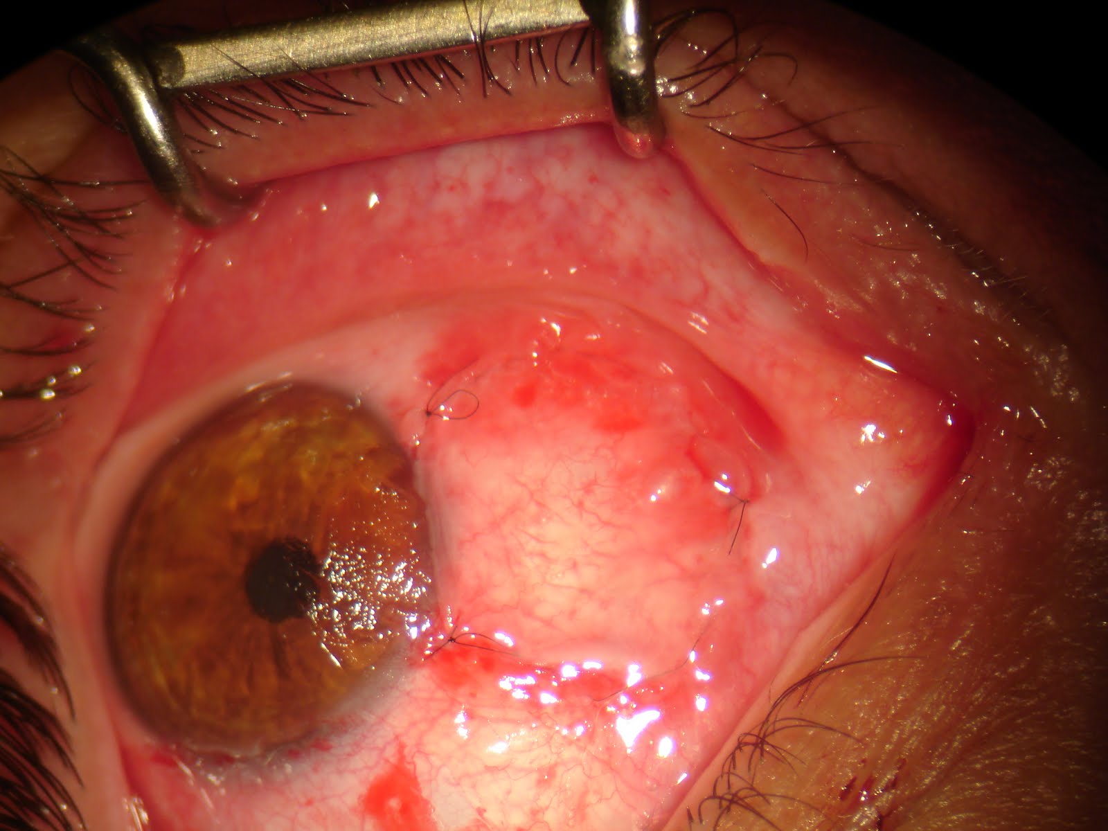 Pterygium Eye Surgery Recovery