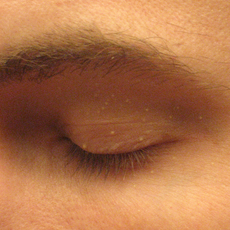 Pterygium Inversum Unguis