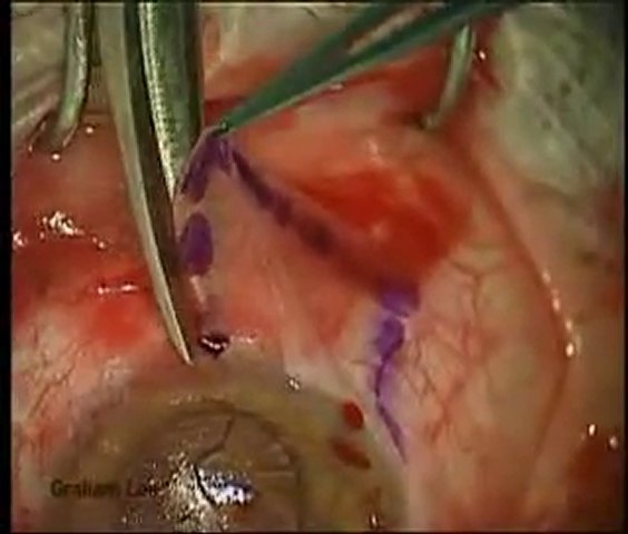 Pterygium Inversum Unguis Pictures