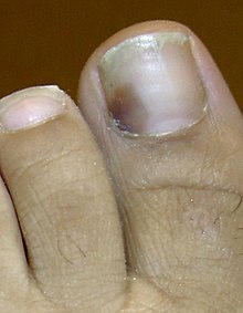 Pterygium Inversum Unguis Toenail