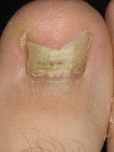 Pterygium Inversum Unguis Toenail