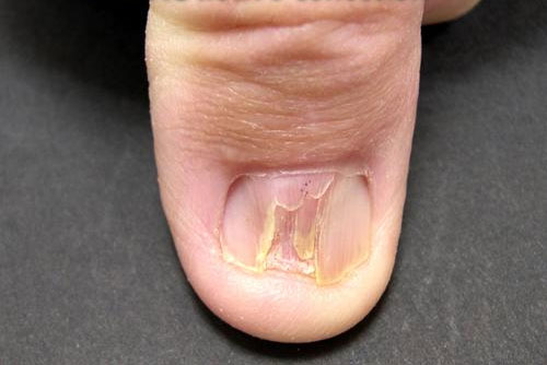 Pterygium Nail