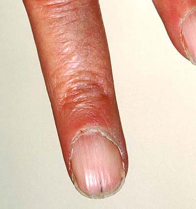 Pterygium Nail